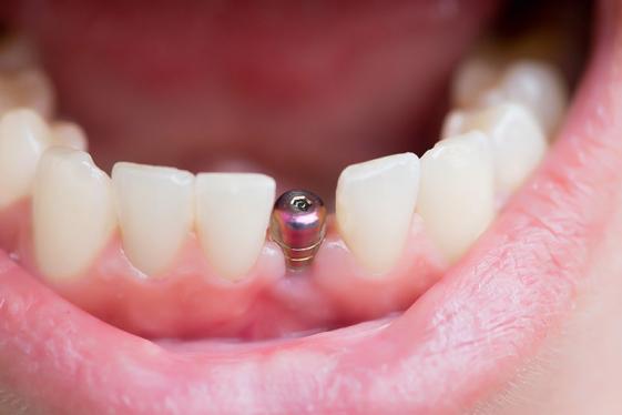 Implants dentaire